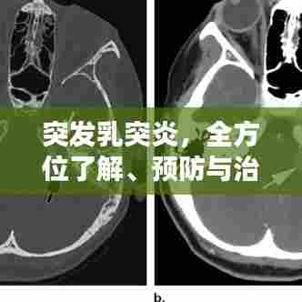 突发乳突炎，全方位了解、预防与治疗策略